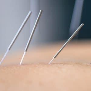 Acupuncture Chronic Pain